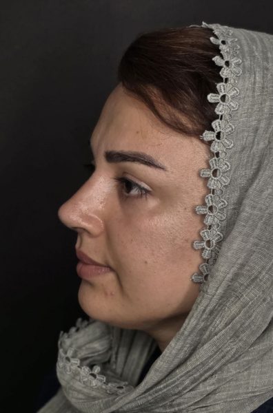 تصویر بعد از عمل